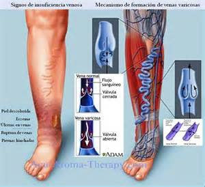 CHECK UP TROMBOSIS VENOSA PROFUNDA (VARICES)